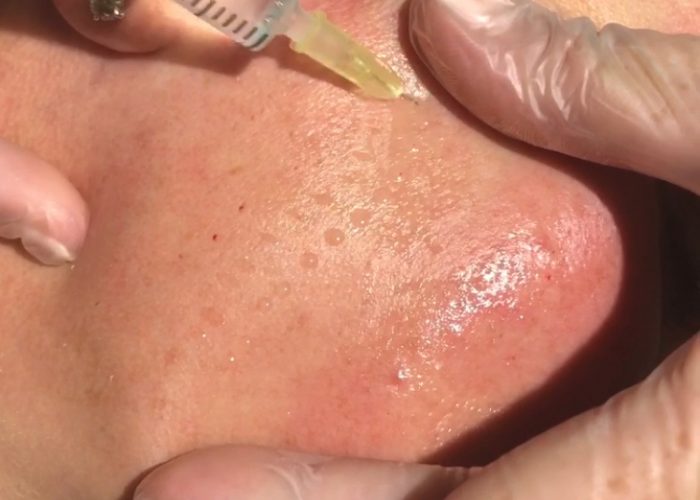 Nappage Mesotherapy - Beauty Salon Ashford Kent