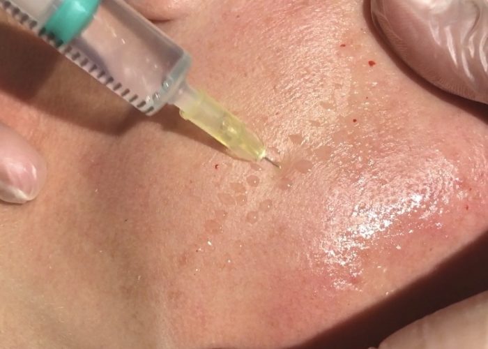 Nappage Mesotherapy - Beauty Salon Ashford Kent