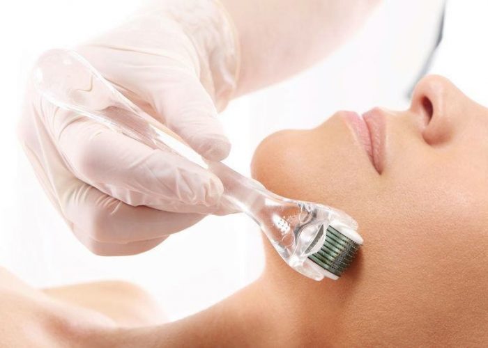 Microneedling - Finchwood Beauty