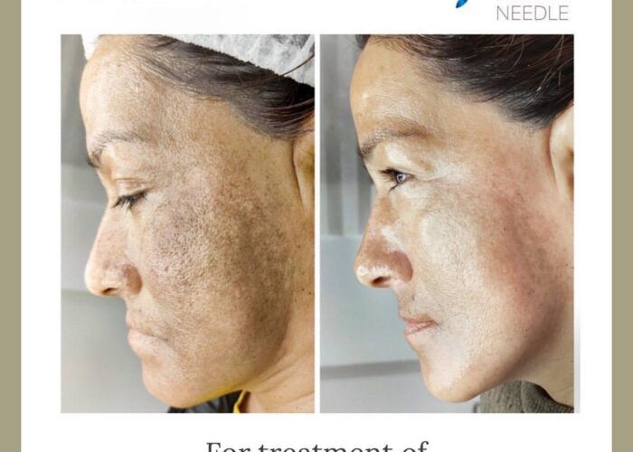 IMG_8190 SQT Bio Microneedling