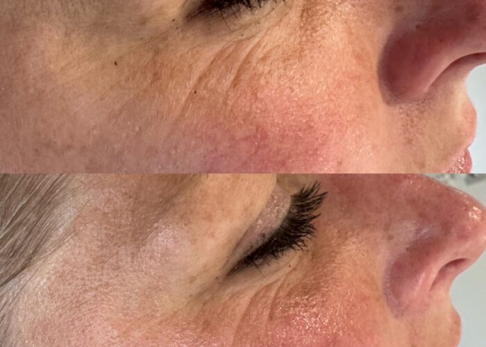 Close up of a woman's face before and after treatment of Skin Tox with a smoother appearance