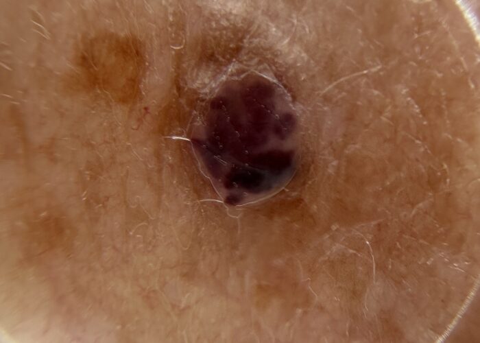 Image of a mole