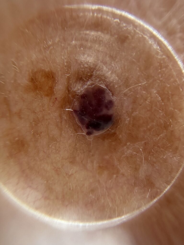 Image of a mole